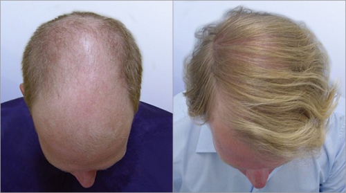 Implant Capillaire Avant Apres Greffe De Cheveux Resultats Et Photos Hospitalavenue Com
